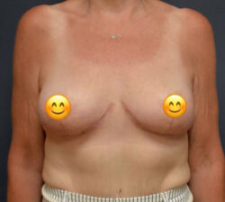Breast Lift