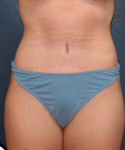 Abdominoplasty