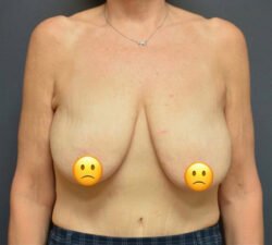 Breast Lift