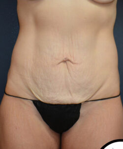 Abdominoplasty