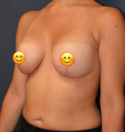 Breast Lift with Augmentation