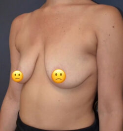 Breast Lift with Augmentation