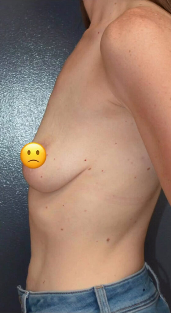 Breast Lift with Augmentation