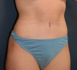 Abdominoplasty