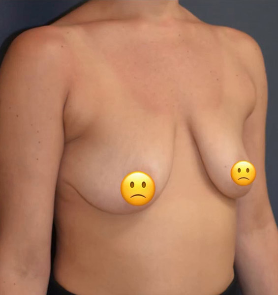 Breast Lift with Augmentation