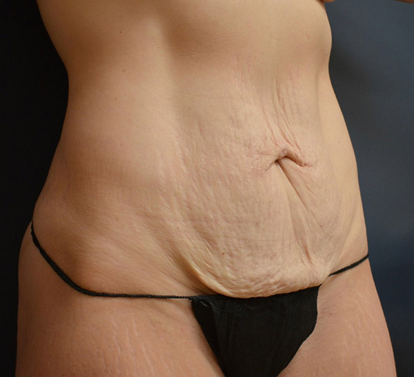 Abdominoplasty