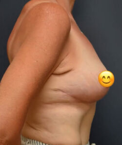 Breast Lift