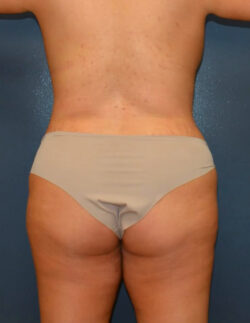 Abdominoplasty
