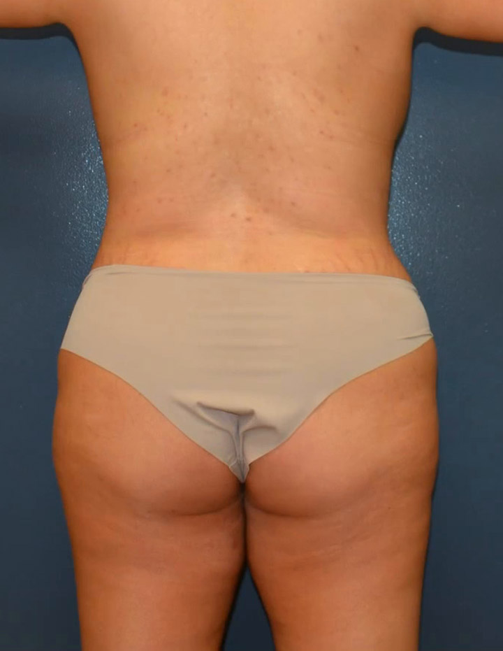 Abdominoplasty