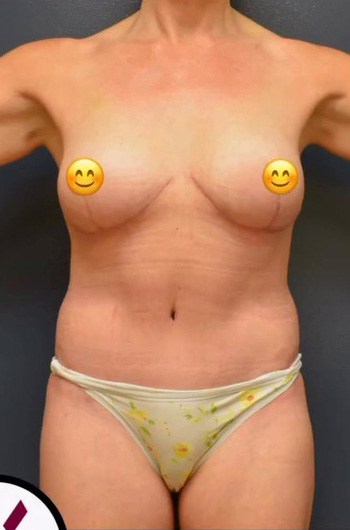 Mommy Makeover