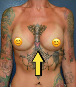 Breast Revision