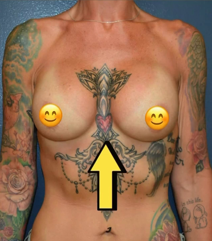 Breast Revision