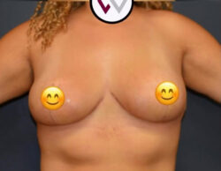 Breast Reduction