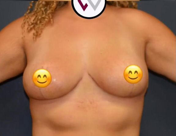 Breast Reduction