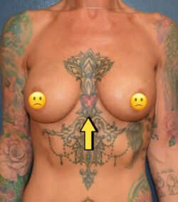 Breast Revision
