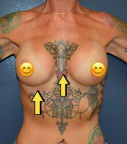 Breast Revision