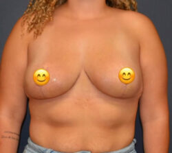 Breast Reduction