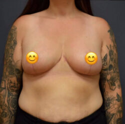 Breast Reduction