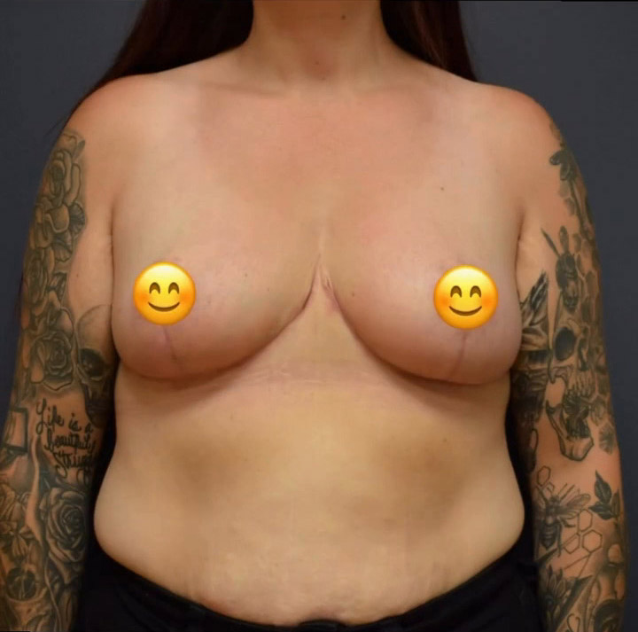 Breast Reduction