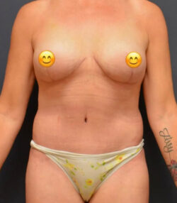 Mommy Makeover