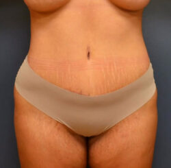 Abdominoplasty