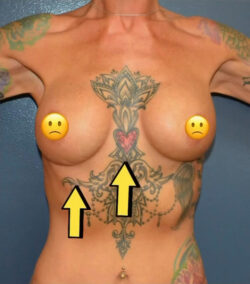 Breast Revision
