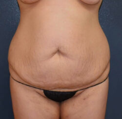 Abdominoplasty