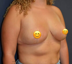 Breast Reduction