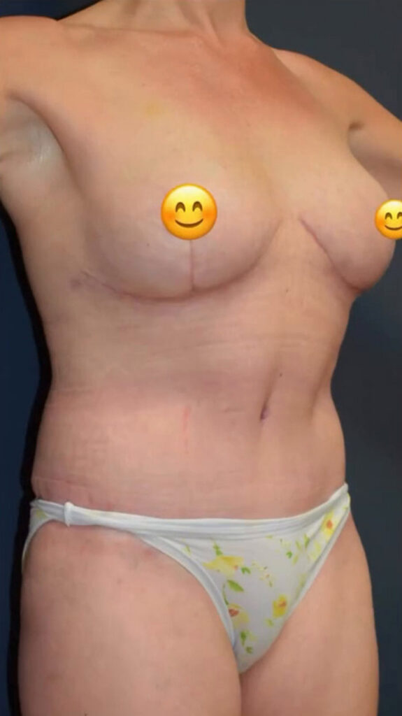 Mommy Makeover