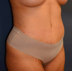 Abdominoplasty