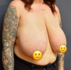 Breast Reduction
