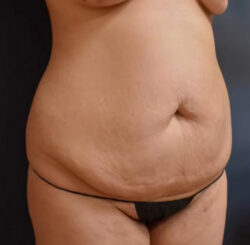 Abdominoplasty