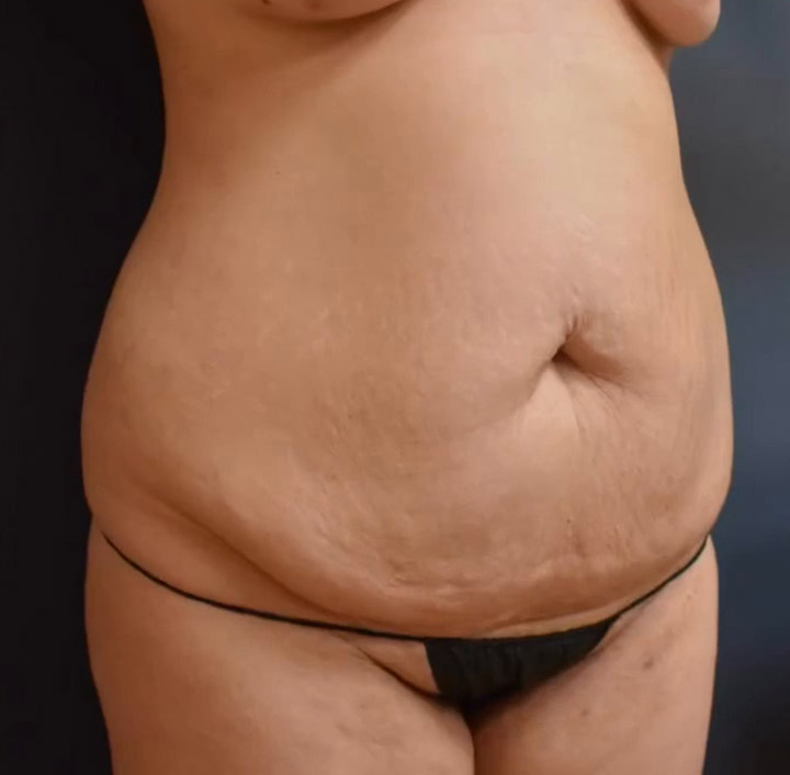 Abdominoplasty