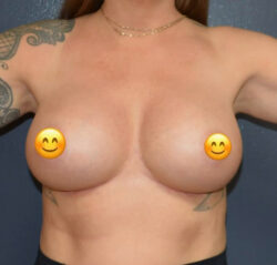 Breast Augmentation