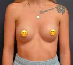 Breast Augmentation