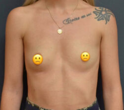 Breast Augmentation
