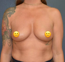 Breast Augmentation