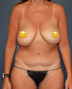 Breast Revision