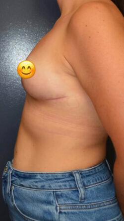 Breast Lift