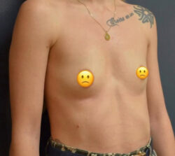 Breast Augmentation