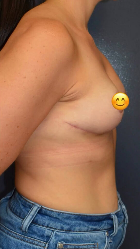Breast Lift