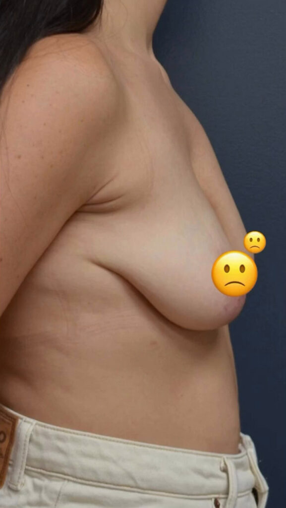 Breast Lift