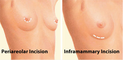 Implant incisions