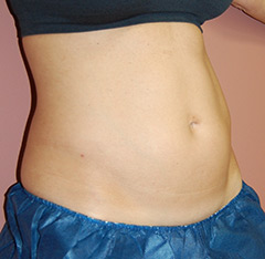 CoolSculpting 1 Before & After