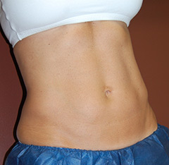 CoolSculpting 2 Before & After