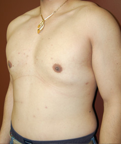 Male Breast Reduction 2 Before & After