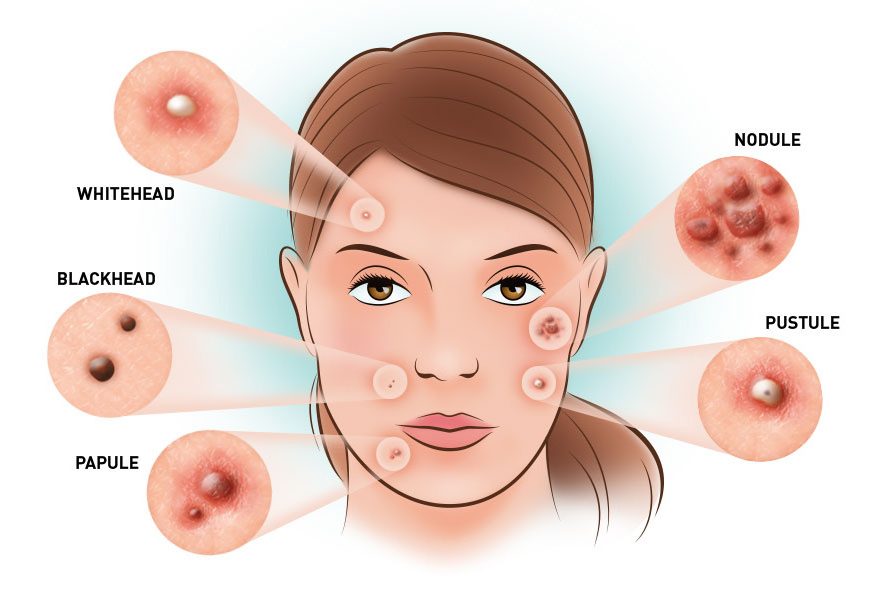 types of acne