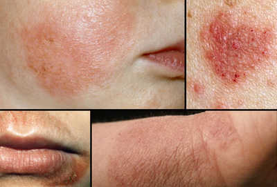 Atopic eczema sales