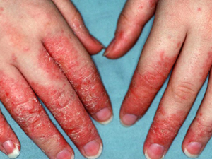 eczema 1