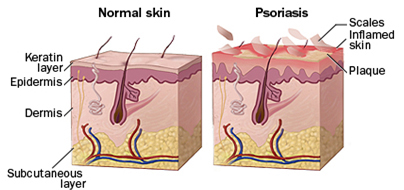 psoriasis treated
